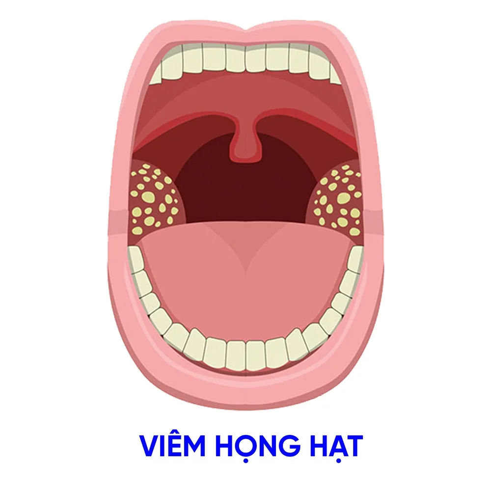 Viêm họng hạt - Nguyên nhân chẩn đoán và điều trị - Hình 2 - Bệnh viện SANTE Bình Thạnh, TP.HCM Viêm họng hạt - Nguyên nhân chẩn đoán và điều trị - Hình 2 - Bệnh viện SANTE Bình Thạnh, TP.HCM