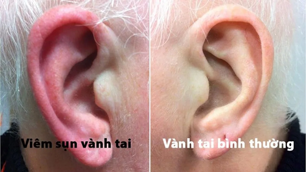 Viêm sụn vành tai và những điều cần biết - Hình 2 - Bệnh viện SANTE Bình Thạnh, TP.HCM Viêm sụn vành tai và những điều cần biết - Hình 2 - Bệnh viện SANTE Bình Thạnh, TP.HCM