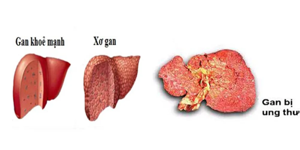 Signs for identifying cirrhosis and liver cancer 1 Recognizing Signs of Cirrhosis and Liver Cancer 1 - SANTE Hospital Binh Thanh, HCMC