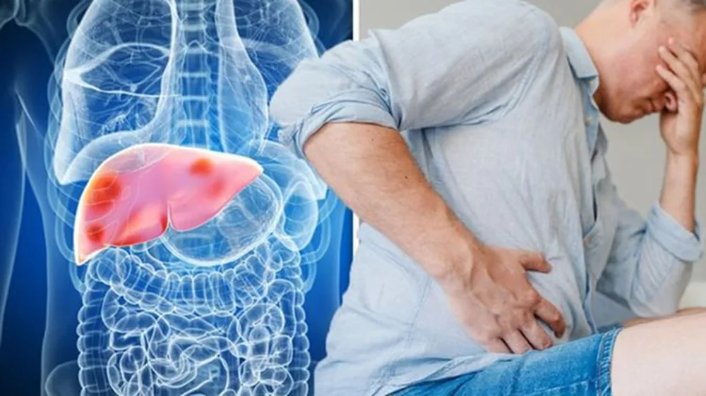Signs for identifying cirrhosis and liver cancer 2 Recognizing Signs of Cirrhosis and Liver Cancer 2 - SANTE Hospital Binh Thanh, HCMC