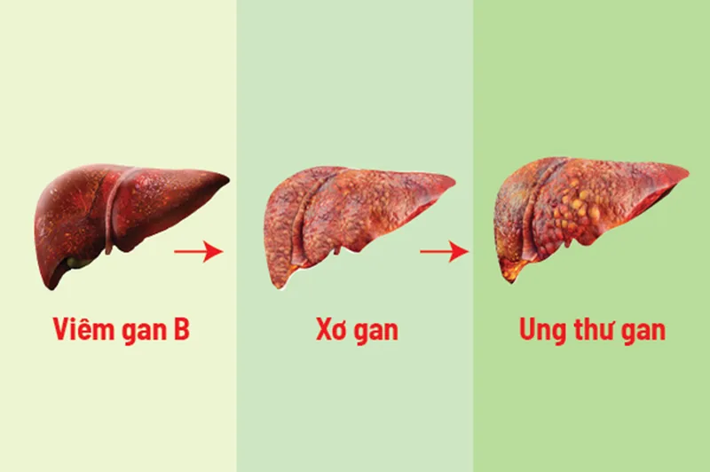 Signs for identifying cirrhosis and liver cancer Recognizing Signs of Cirrhosis and Liver Cancer - SANTE Hospital Binh Thanh, HCMC